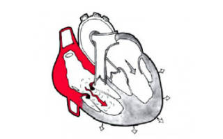 Гипертрофия правого предсердия сердца что это и как можно лечить