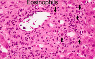 Лечение эозинофилы повышены