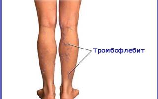 Сколько стоит операция тромбофлебит нижних конечностей