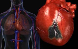 Длительность нетрудоспособности при инфаркте миокарда