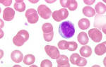 Понижены лимфоциты в крови: лечение лимфоцитопении, как повысить лимфоциты