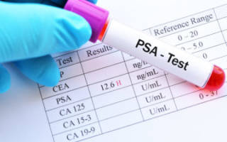 Исследование крови на ПСА свободный норма и возможные отклонения