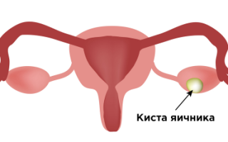 Киста яичника — причины, симптомы и виды — способы лечения